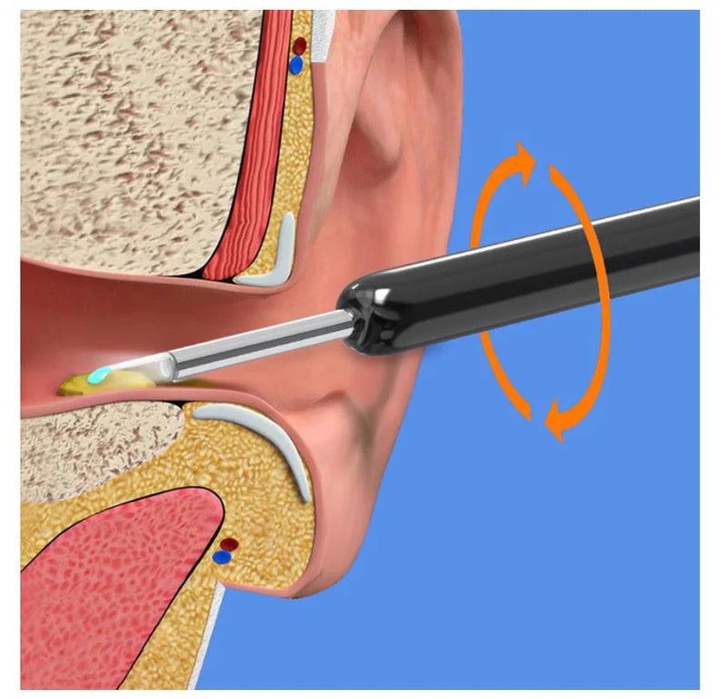 مجموعة إزالة شمع الأذن Smart Ear Cleaner™