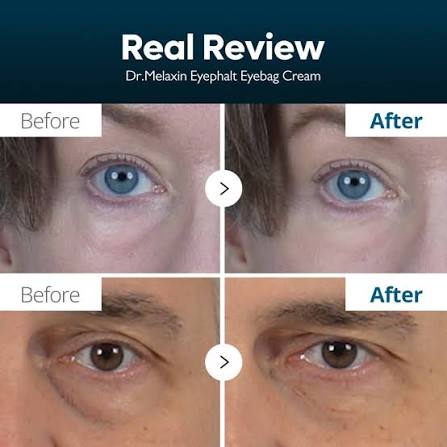 Dr. Melaxin™ Eyephalt Eye Cream For Dark Circles & Puffy Eyes