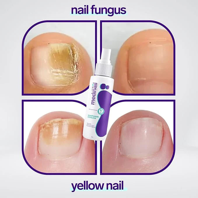 Aysuin Nail Fungus Spray™